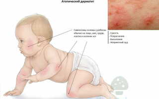 Опасность возникновения атопического дерматита у детей: способы лечения и профилактики