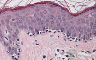 Поражения рогового слоя кожи в следствии кератомикозов