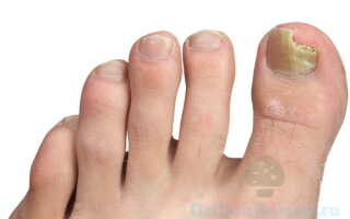 При образовании грибка ногтя на большом пальце ноги лечение какого рода применить?