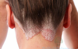 Диагностирование и лечение трихофитии волосистой части головы