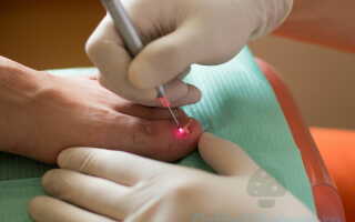 Современный метод лечения грибка ногтей лазером