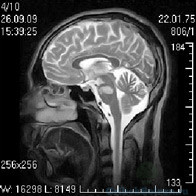 аспергиллез головного мозга