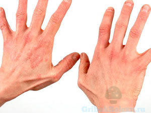 Раздражение кожи рук