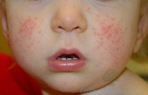 Аллергия малыша