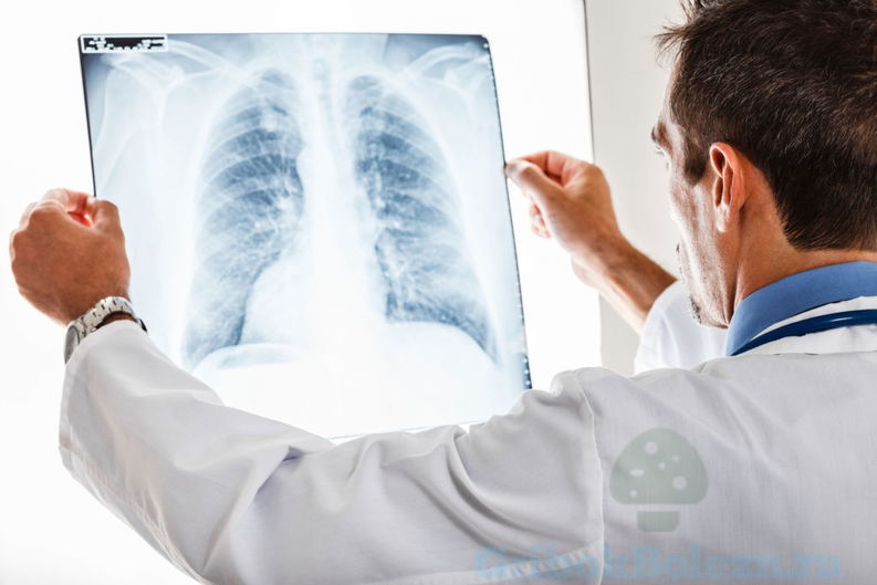 снимок лёгких