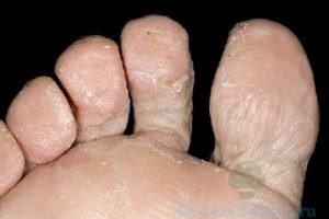 грибок кожи ног